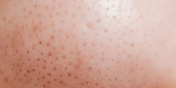 How to get rid of Blackheads with Hydrogen Peroxide